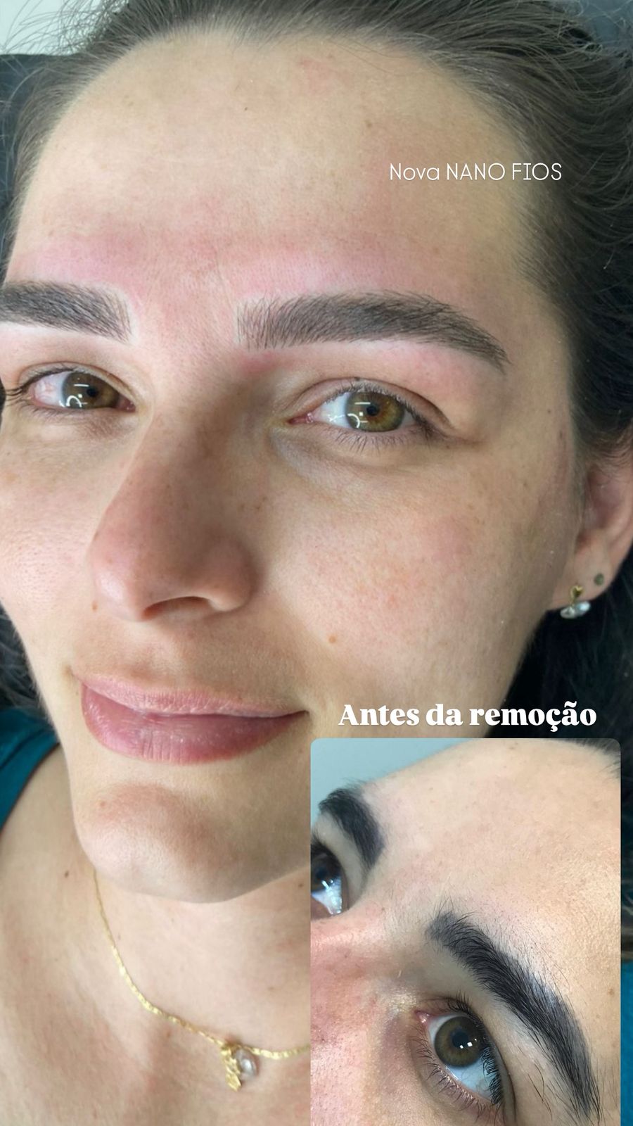 Antes e depois Belfort Beauty 2