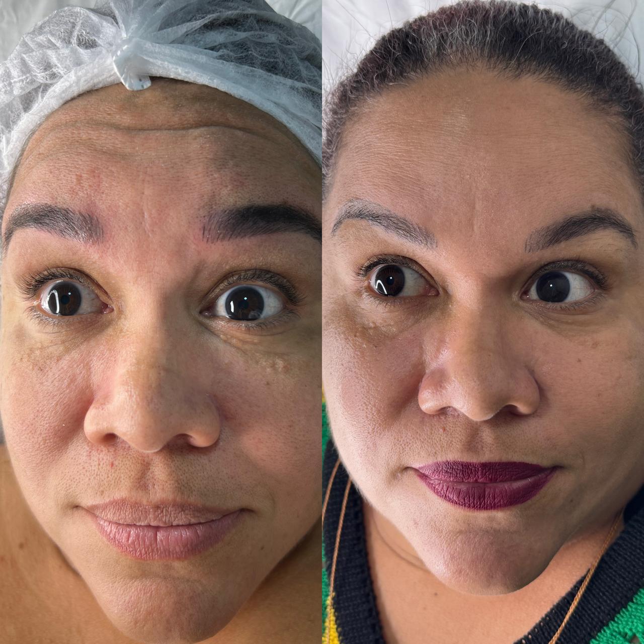 Resultado de Botox