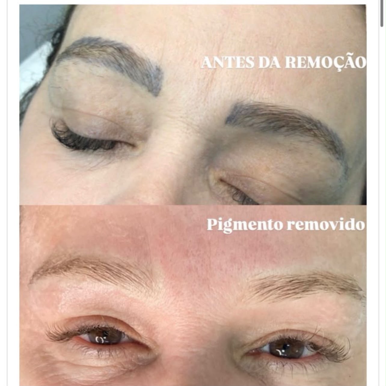 Resultado de remoção de pigmento a laser