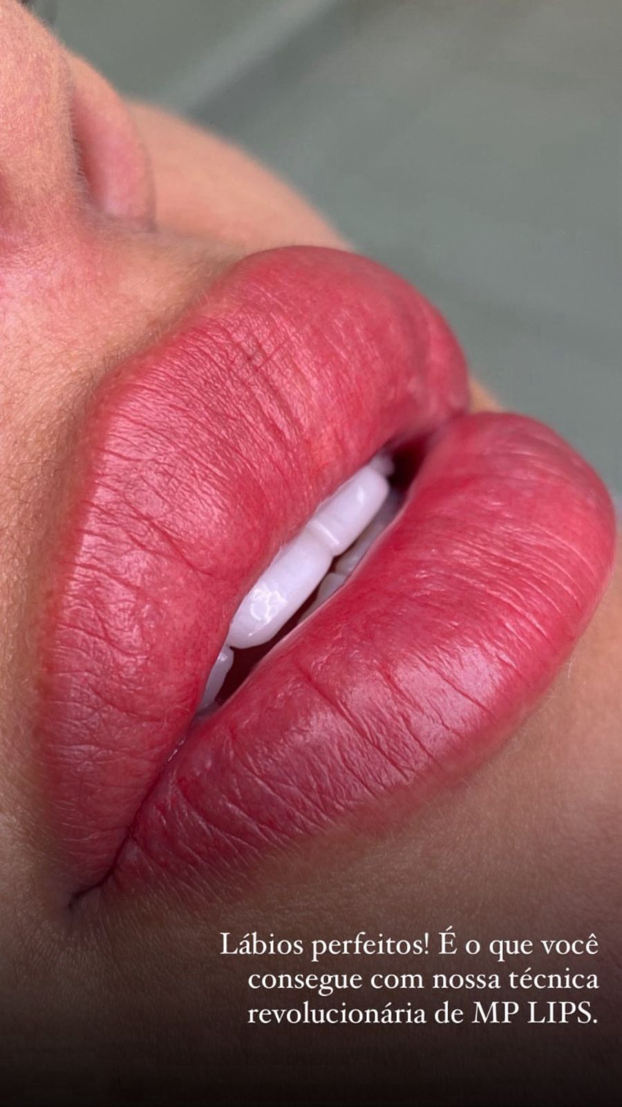 Resultado labial Belfort Beauty 8